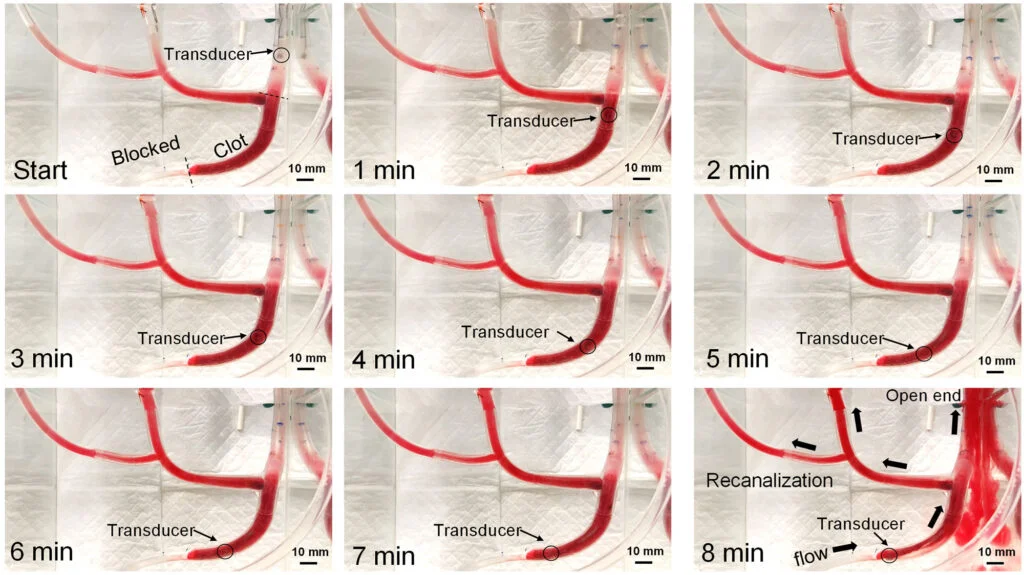 Revolutionizing Pulmonary Embolism Treatment with Vortex Ultrasound Technology